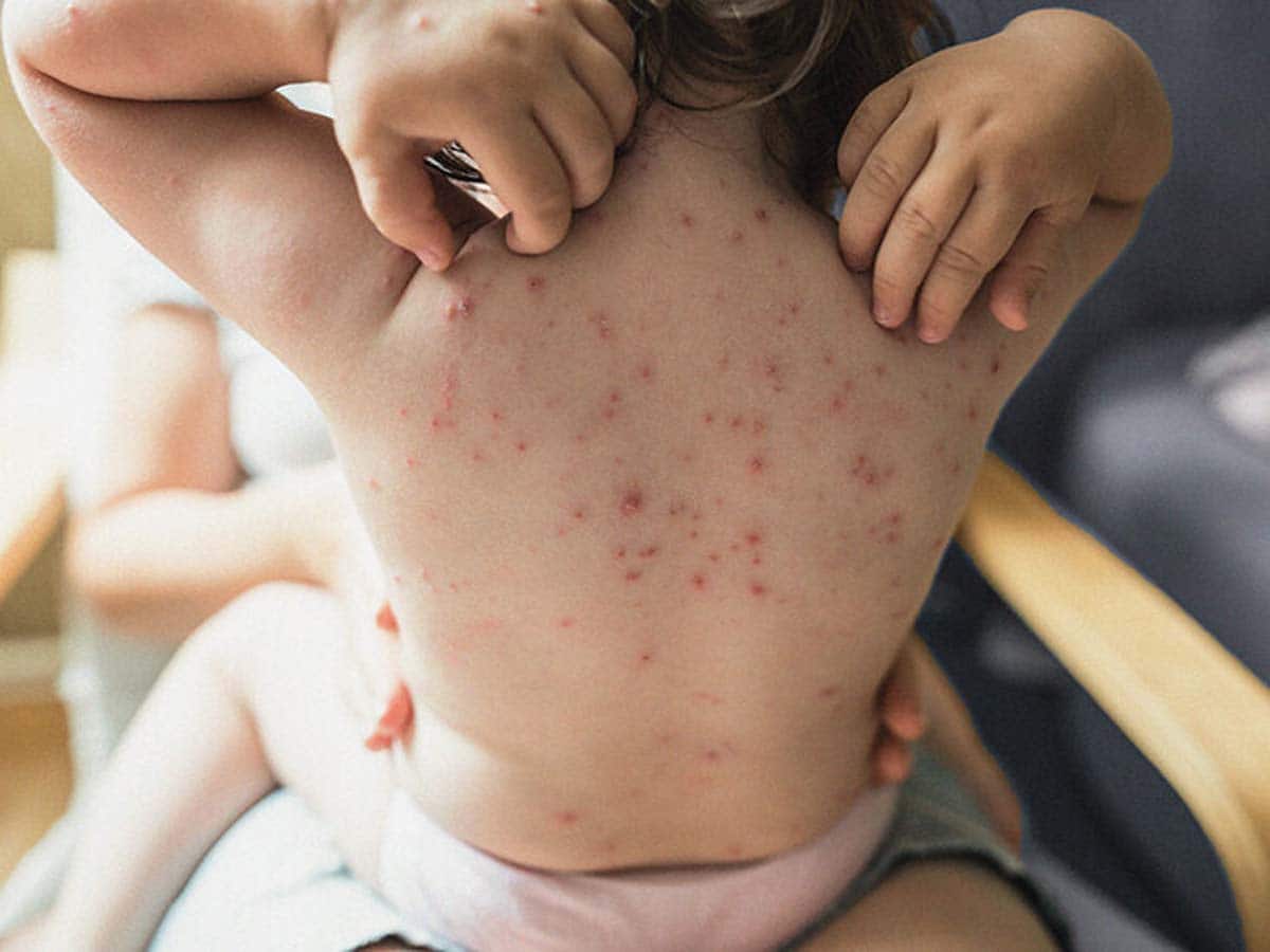 Getting Chickenpox Can Increase Alzheimer's Risk: How To Manage It